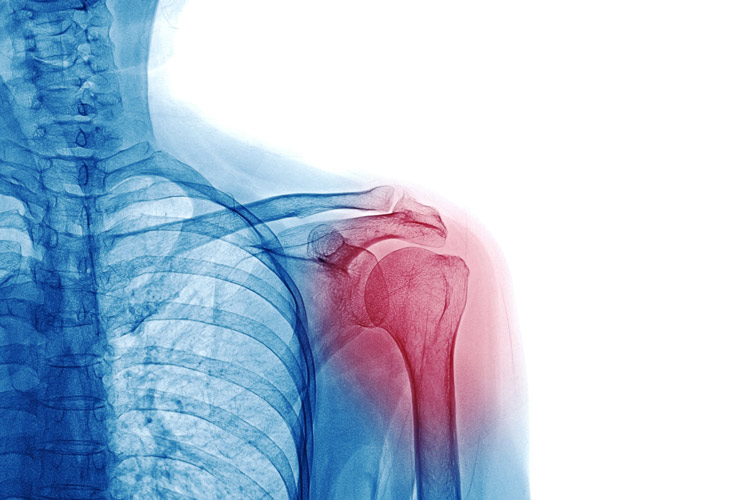 Shoulder Joint PRP Houston TX OB Men Wellness